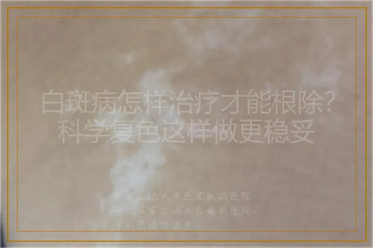 白斑病怎样治疗才能根除?科学复色这样做更稳妥