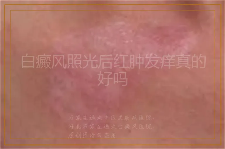 白癜风照光后红肿发痒真的好吗