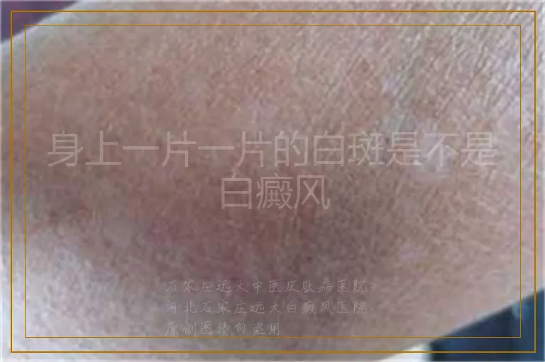 身上一片一片的白斑是不是白癜风
