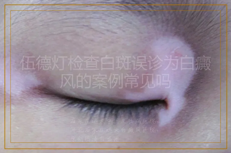 伍德灯检查白斑误诊为白癜风的案例常见吗
