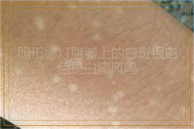 照伍德灯胳膊上的白斑银白色是白癜风吗