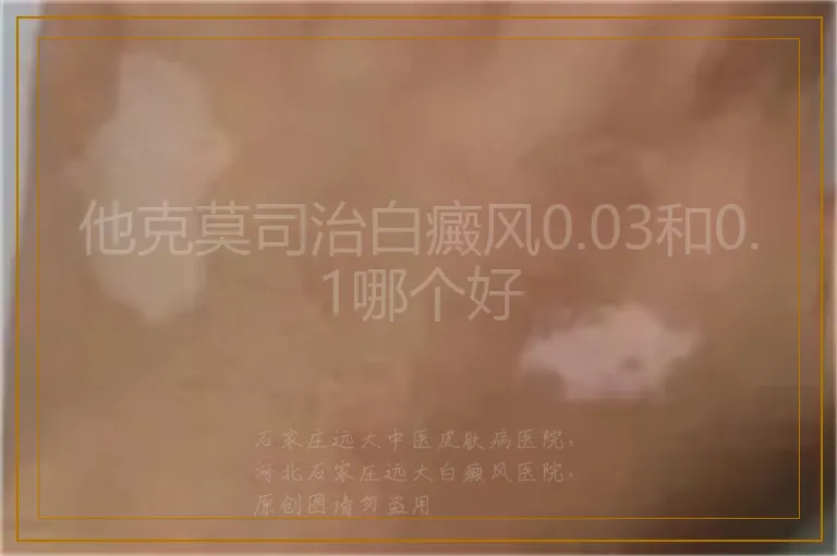 他克莫司治白癜风0.03和0.1哪个好