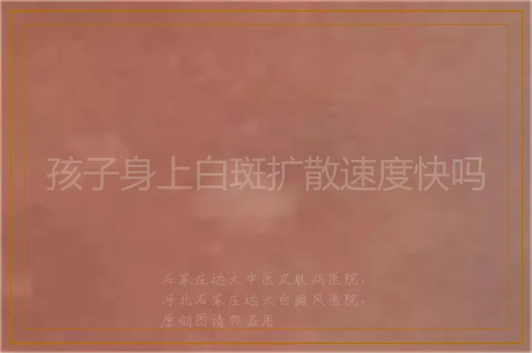 孩子身上白斑扩散速度快吗