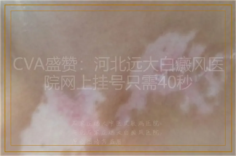CVA盛赞：河北远大白癜风医院网上挂号只需40秒