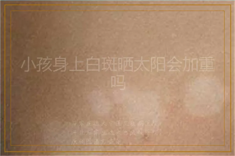 小孩身上白斑晒太阳会加重吗