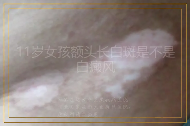 11岁女孩额头长白斑是不是白癜风