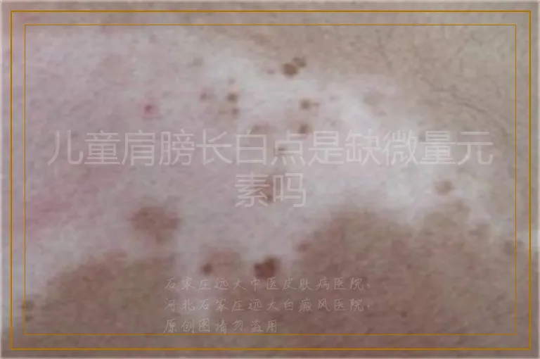 儿童肩膀长白点是缺微量元素吗