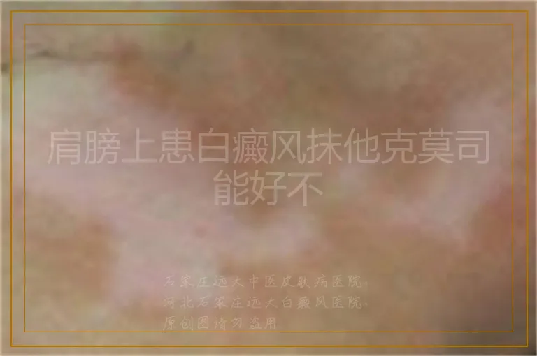 肩膀上患白癜风抹他克莫司能好不
