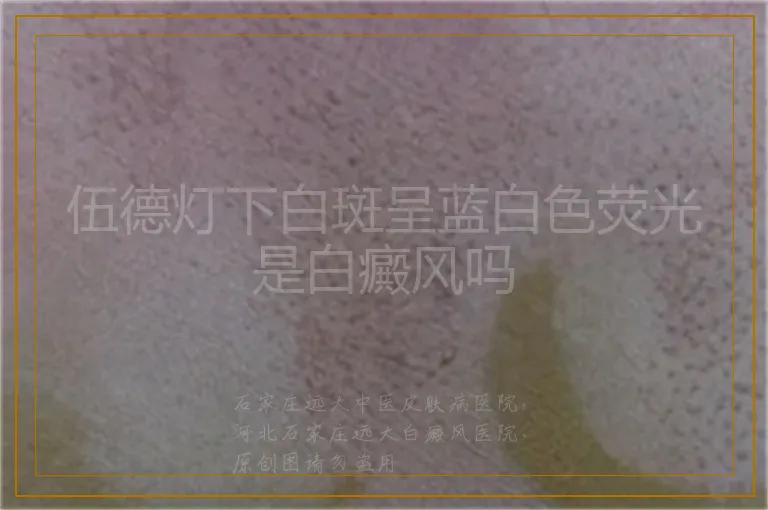 伍德灯下白斑呈蓝白色荧光是白癜风吗