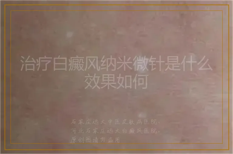 治疗白癜风纳米微针是什么效果如何