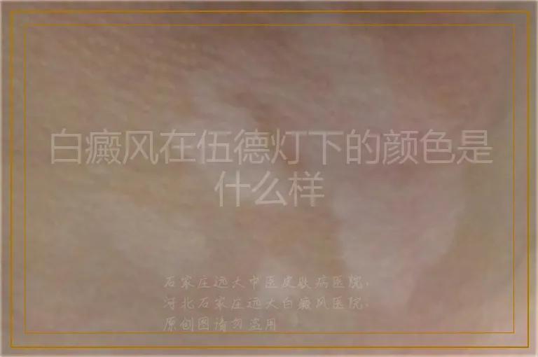 白癜风在伍德灯下的颜色是什么样