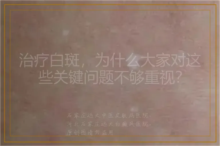治疗白斑，为什么大家对这些关键问题不够重视？