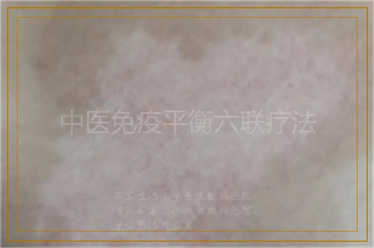 中医免疫平衡六联疗法