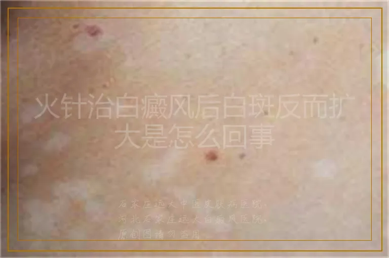 火针治白癜风后白斑反而扩大是怎么回事