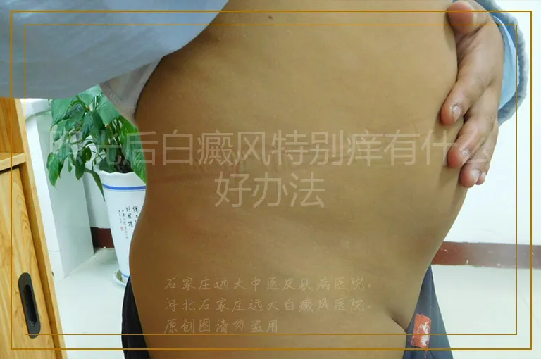 照光后白癜风特别痒有什么好办法