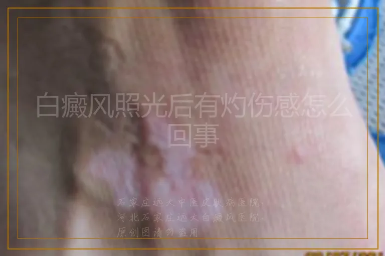 白癜风照光后有灼伤感怎么回事