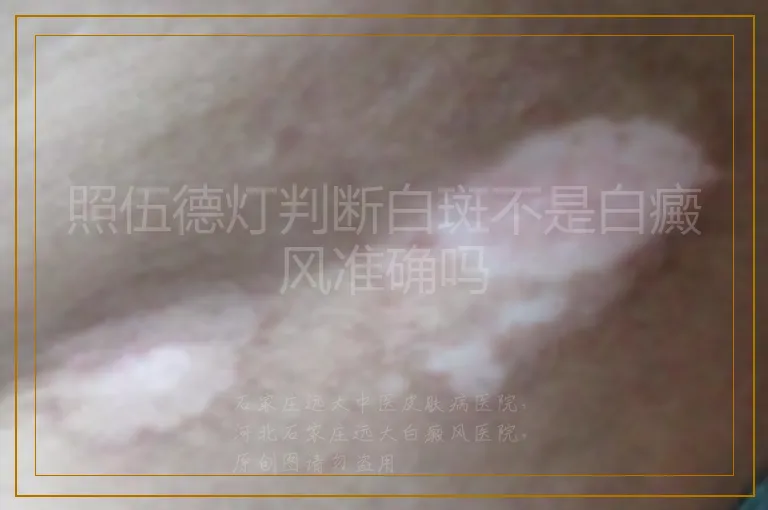 照伍德灯判断白斑不是白癜风准确吗