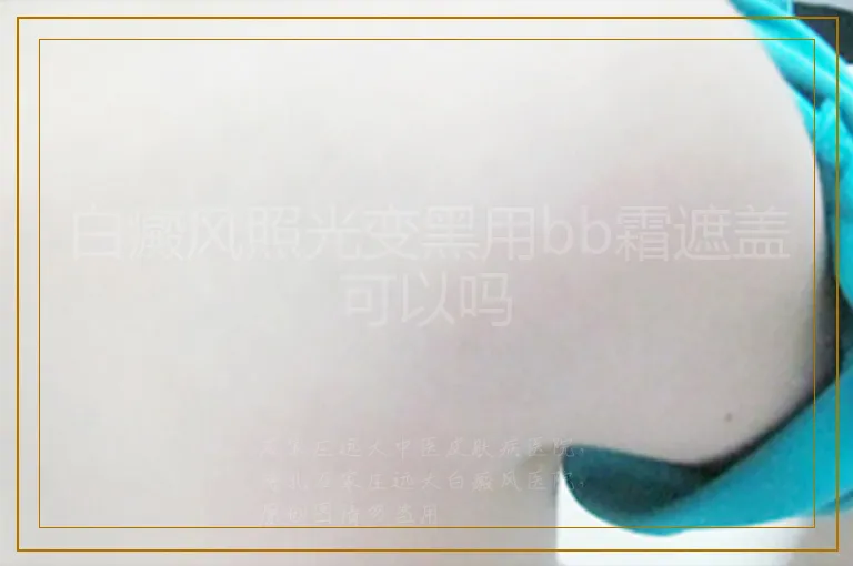 白癜风照光变黑用bb霜遮盖可以吗