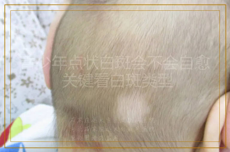 青少年点状白斑会不会自愈 关键看白斑类型