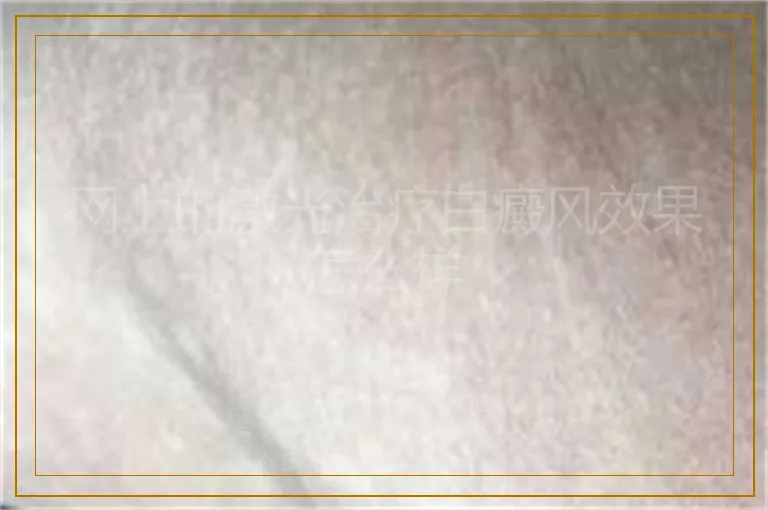 网上的激光治疗白癜风效果怎么样