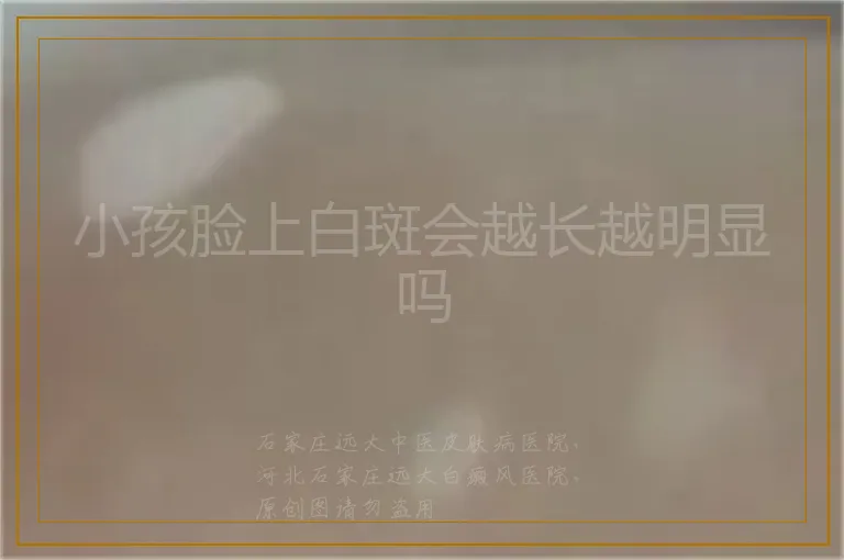 小孩脸上白斑会越长越明显吗