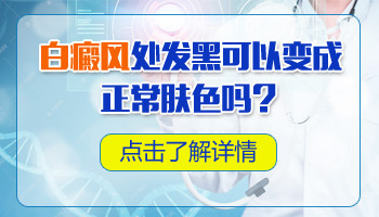 儿童面部巴掌大白斑怎么治疗有康复案例吗