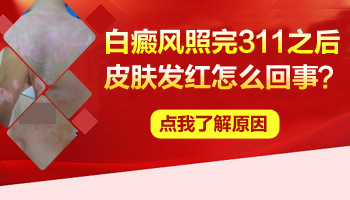 儿童下巴有白斑照308激光多长时间有好转