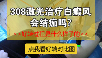 儿童脚部有白斑只照308激光能控制住吗