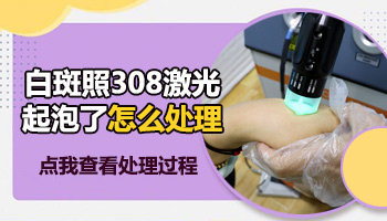 儿童头部有白块只照308激光能控制住吗