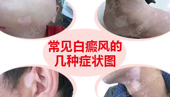 女性脸上长白癜风照完308红多久是正常的